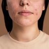 Tratamientos naturales para combatir el Acné