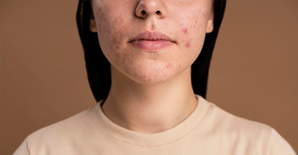 Tratamientos naturales para combatir el Acné